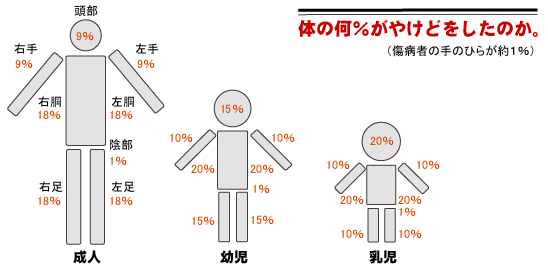 熱傷（やけど）の広さを判断する図